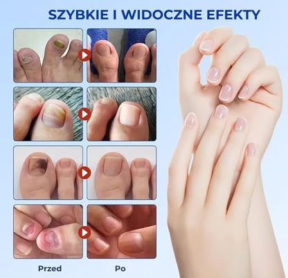 Plastry na grzybicę paznokci (skuteczne wsparcie dla zdrowych paznokci)