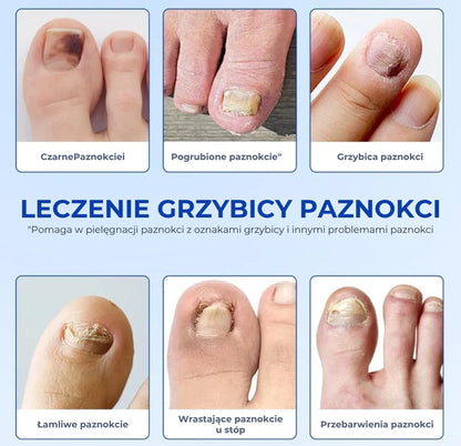 Plastry na grzybicę paznokci (skuteczne wsparcie dla zdrowych paznokci)